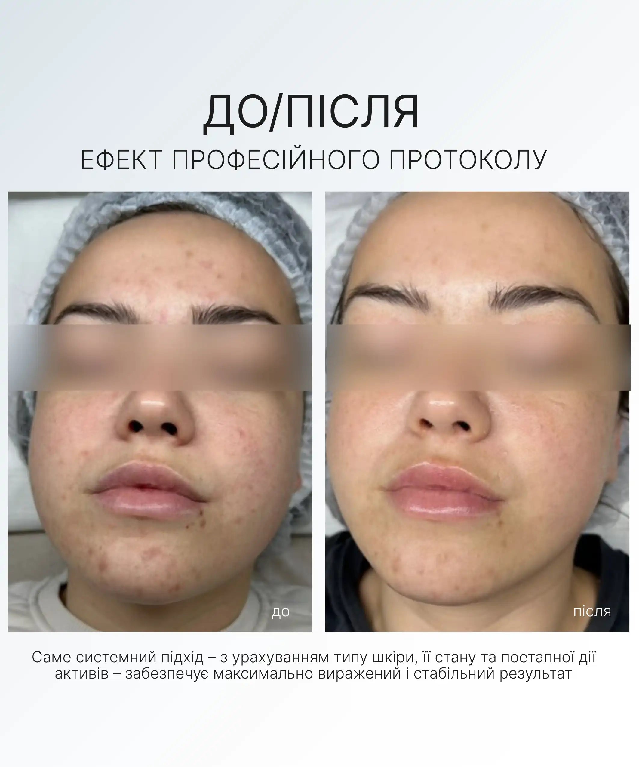 НАБІР ДЛЯ ЛІКУВАННЯ ТА ПРОФІЛАКТИКИ АКНЕ AG SKIN