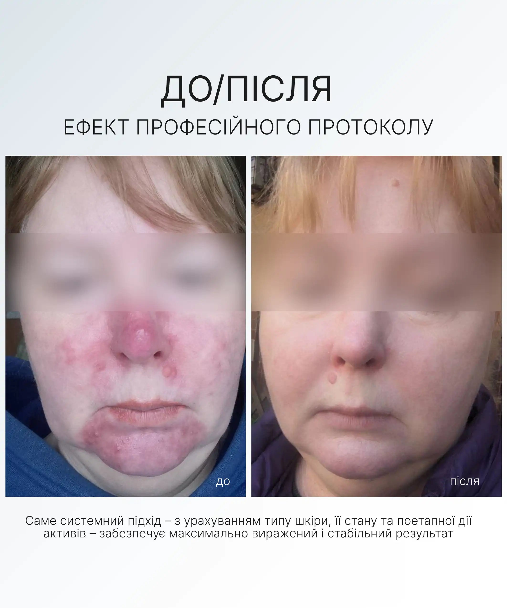 НАБІР ДЛЯ ЛІКУВАННЯ ТА ПРОФІЛАКТИКИ РОЗАЦЕА AG SKIN